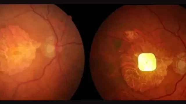Electronic Eye Implant Restores Sight in AMD Patients